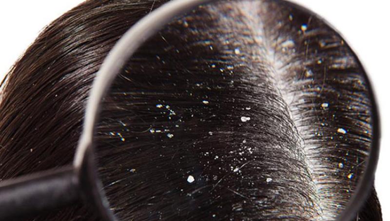 Dandruff and Ayurvedic treatments
