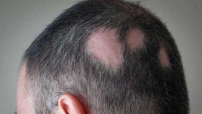 Alopecia Areata